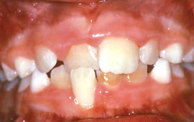 Crossbite of the front teeth, with an upper tooth biting inside the lower teeth